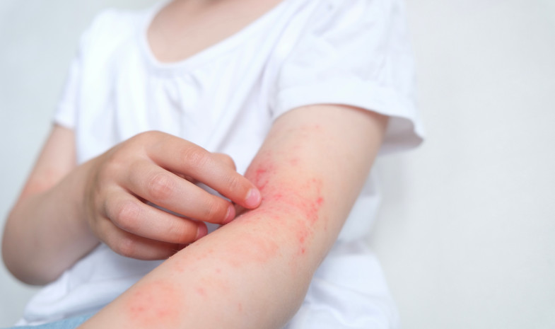 ¿Cuál es el origen de la Dermatitis Atópica?