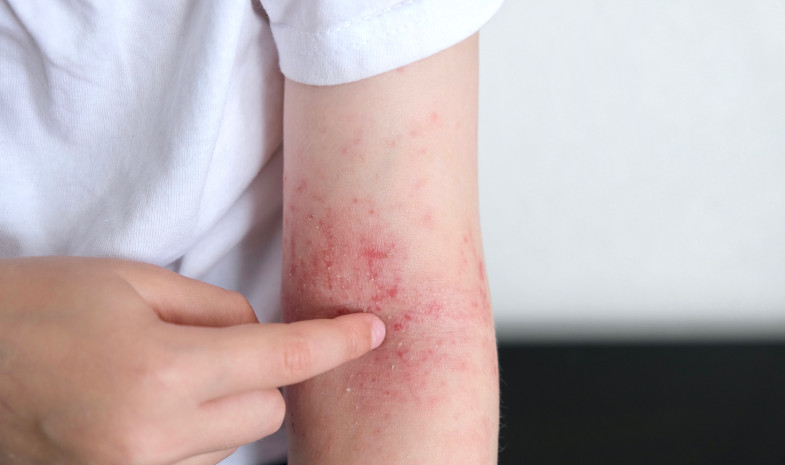 Signos y síntomas de la Dermatitis Atópica