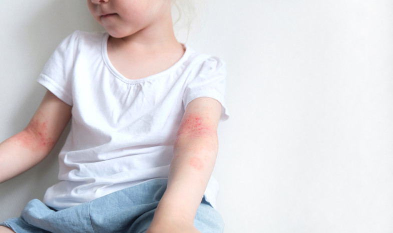 14 de septiembre. Día Mundial de la Dermatitis Atópica